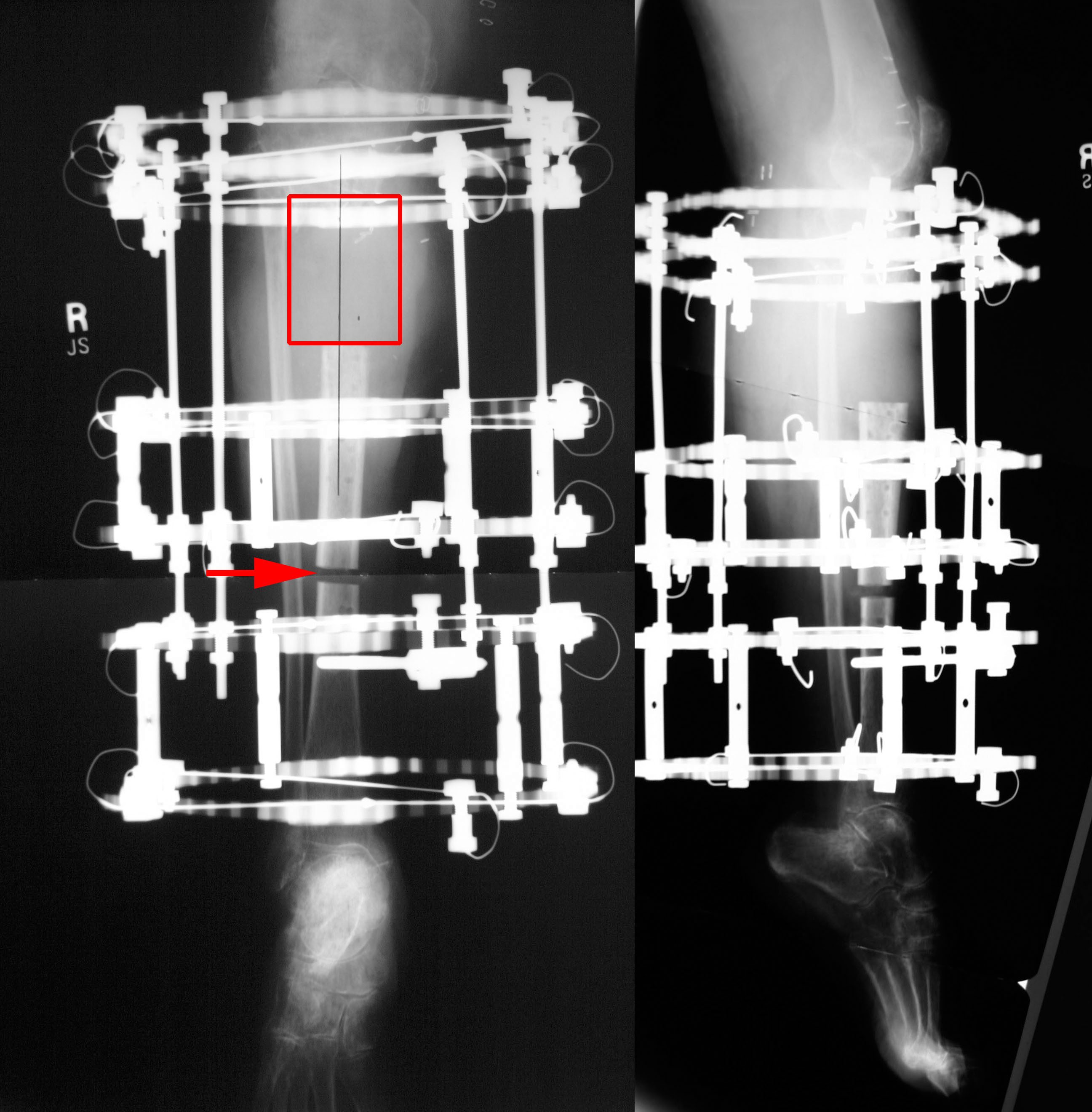 Double-level, proximal-to-distal bone transport using wire fixation. A
