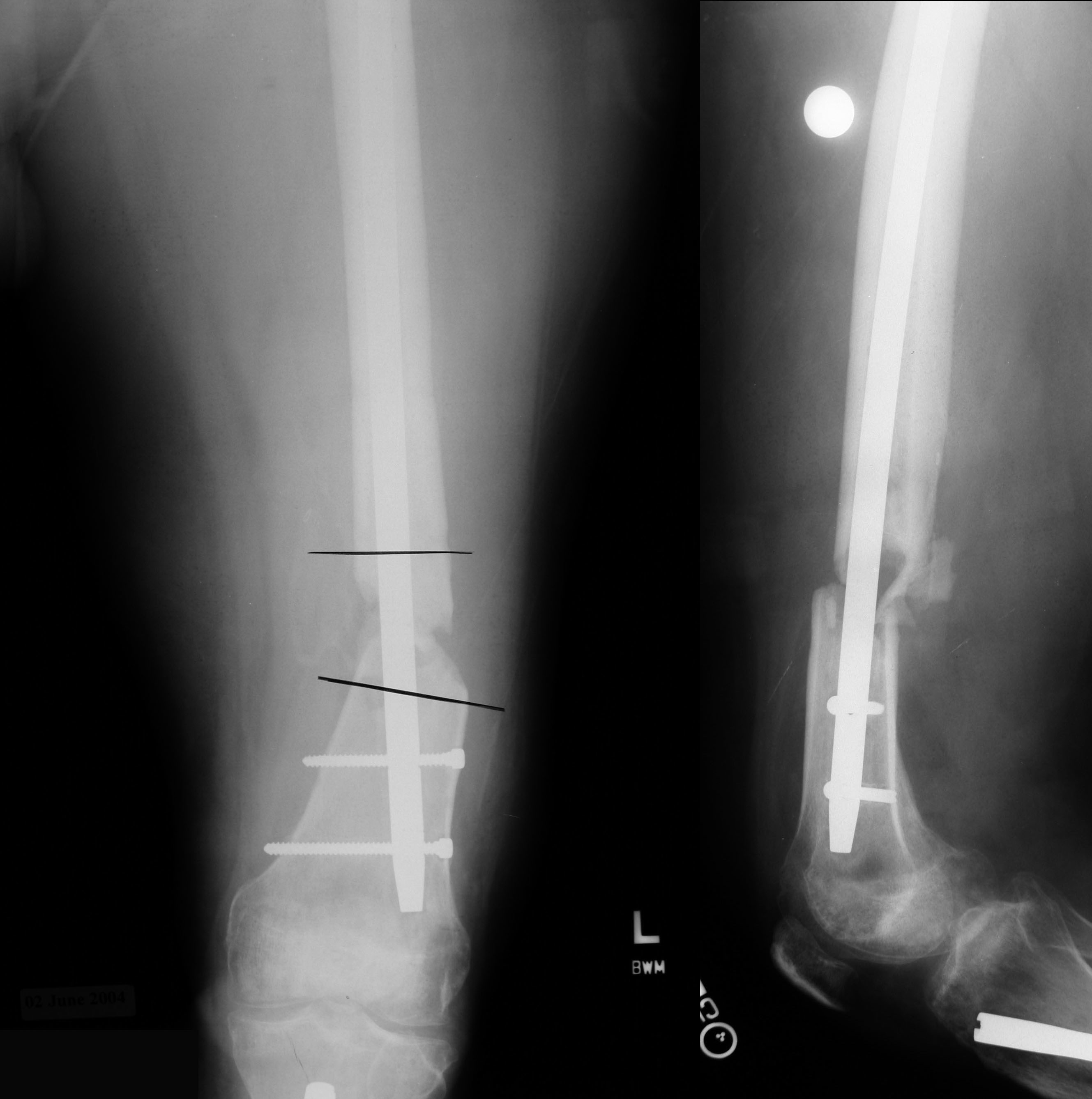 nonunion-femur-case-4-dr-mark-brinker-houston-orthopedic-surgeon