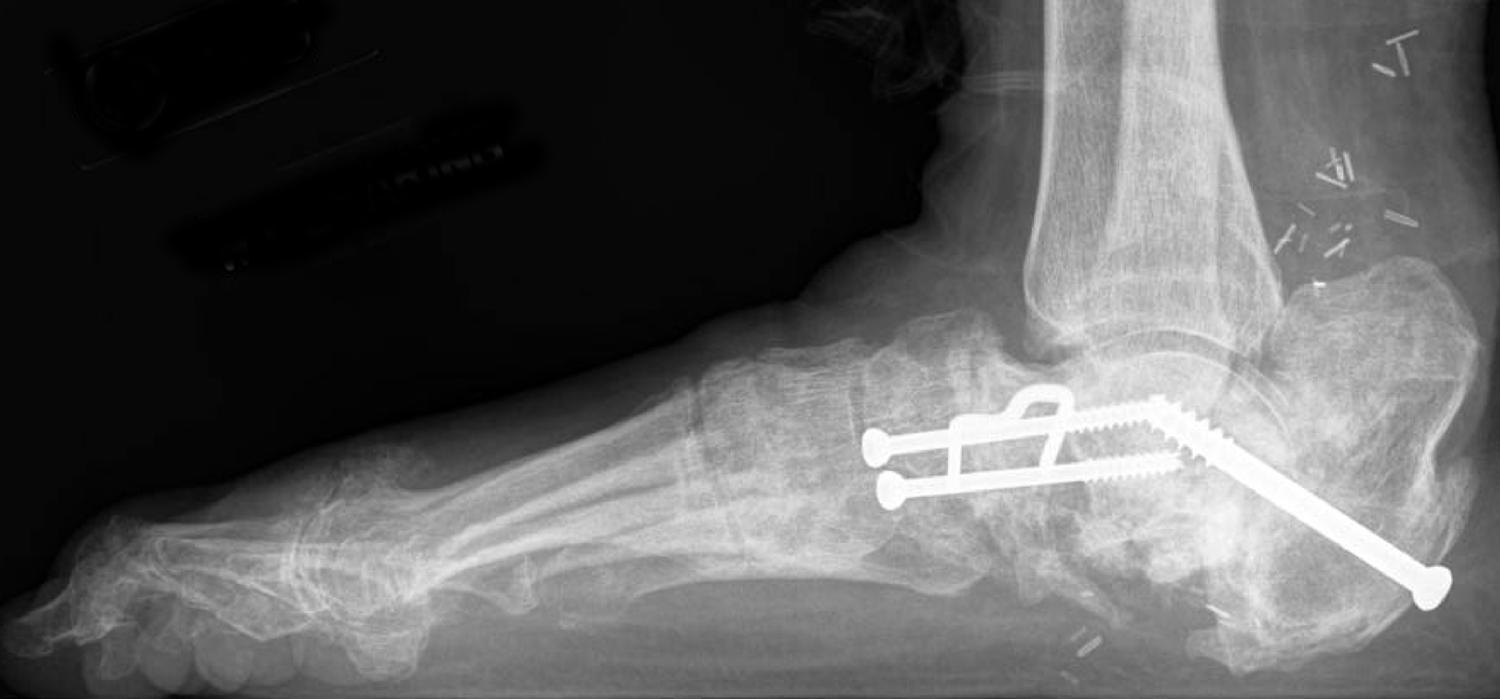 Bone Infection: Foot - Dr. Mark Brinker, Houston Orthopedic Surgeon