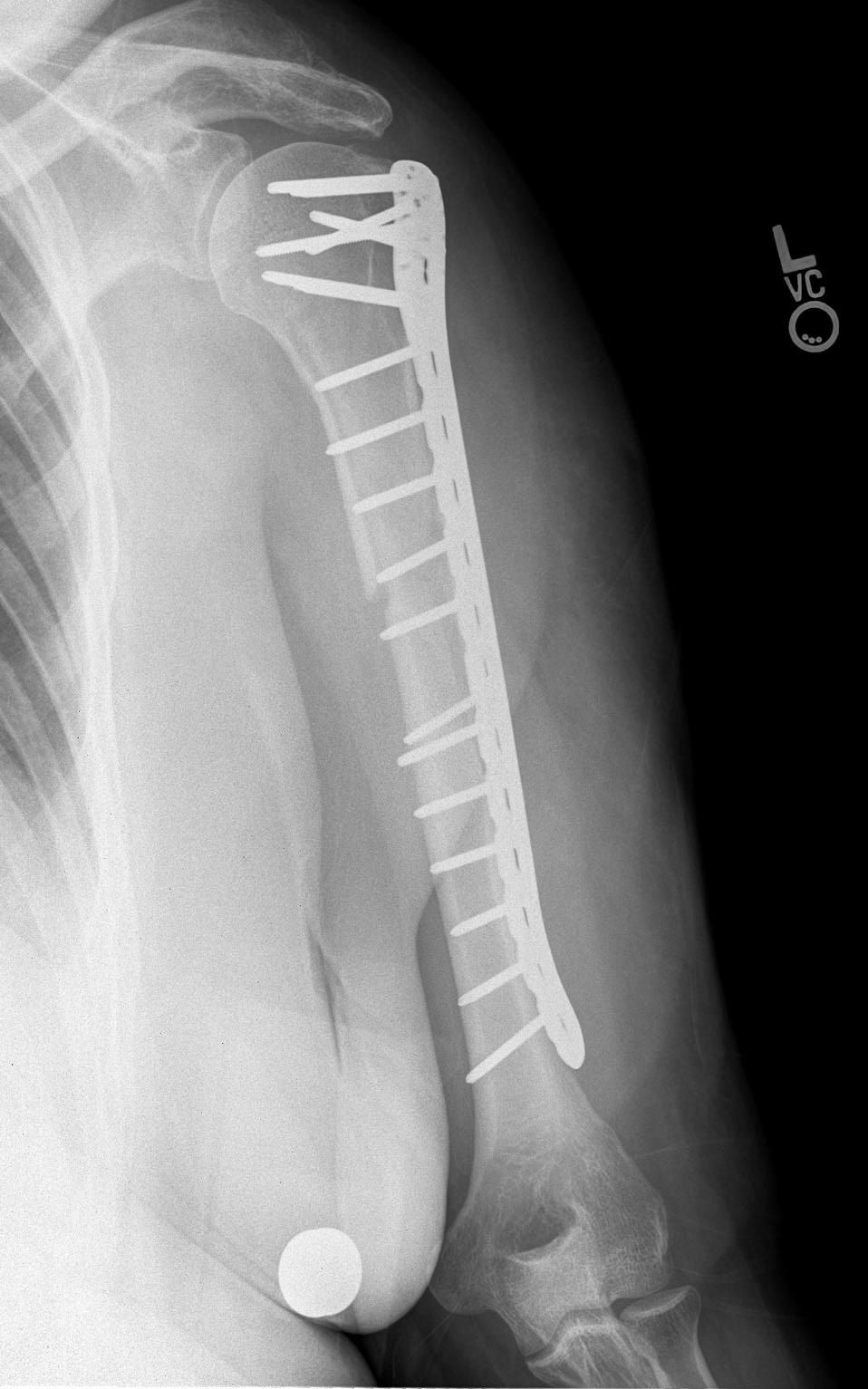 humerus fracture surgery plate recovery time