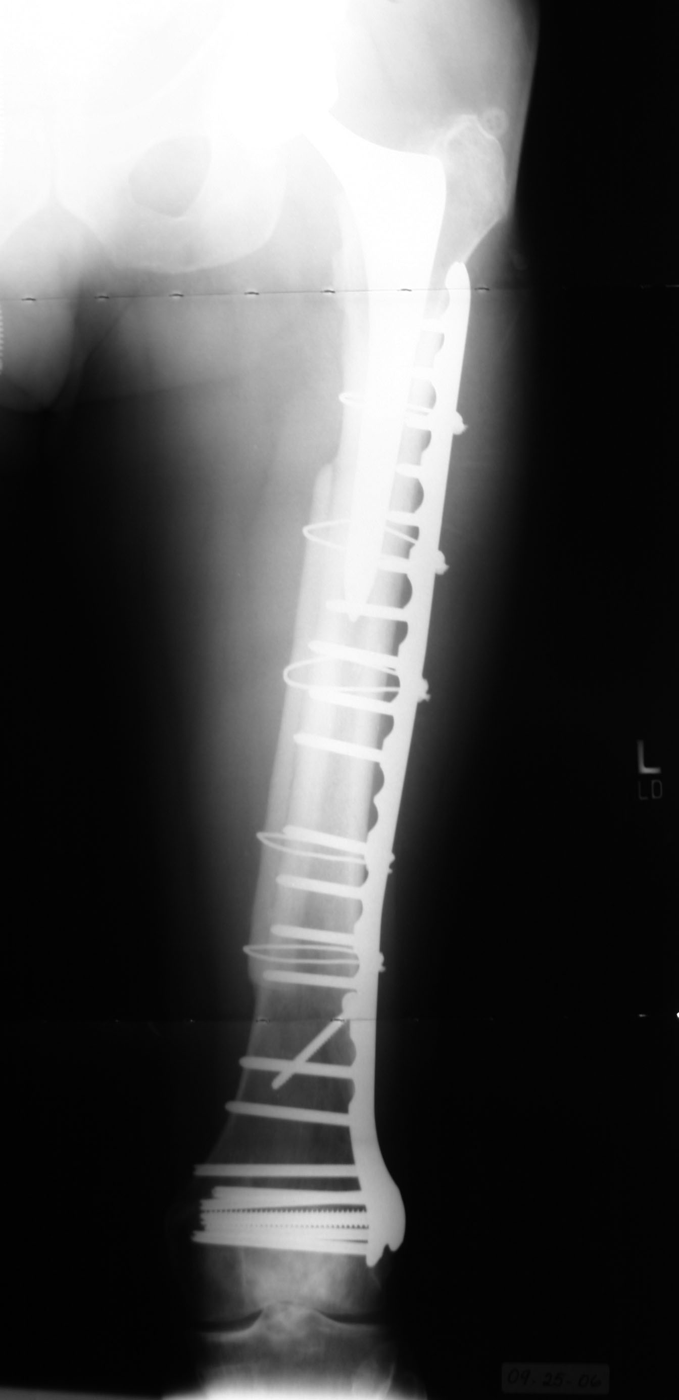 treatment of a spiral fracture